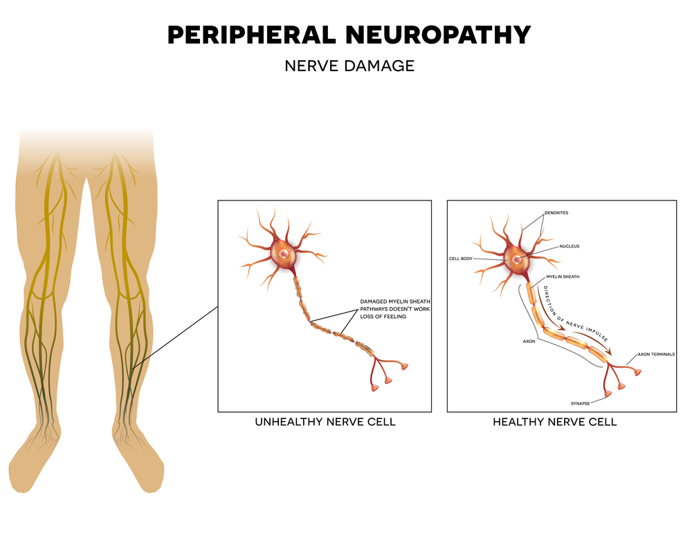 How bad can Peripheral Neuropathy get? The 7 Long term effects