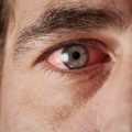 Eye Allergies Causes and Symptoms