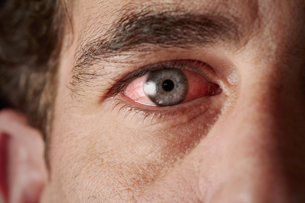 Eye Allergies Causes and Symptoms