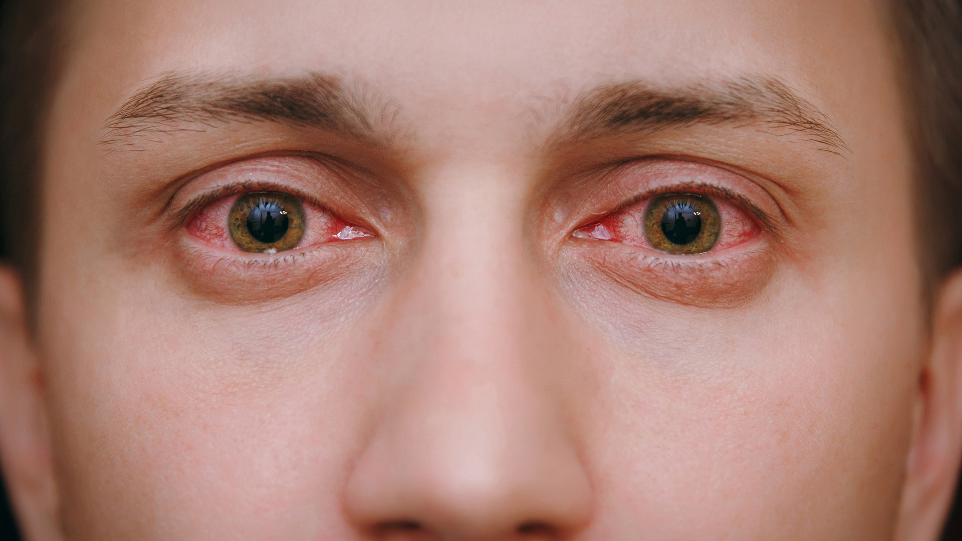 Allergic Conjunctivitis: Types, Causes, and Symptoms