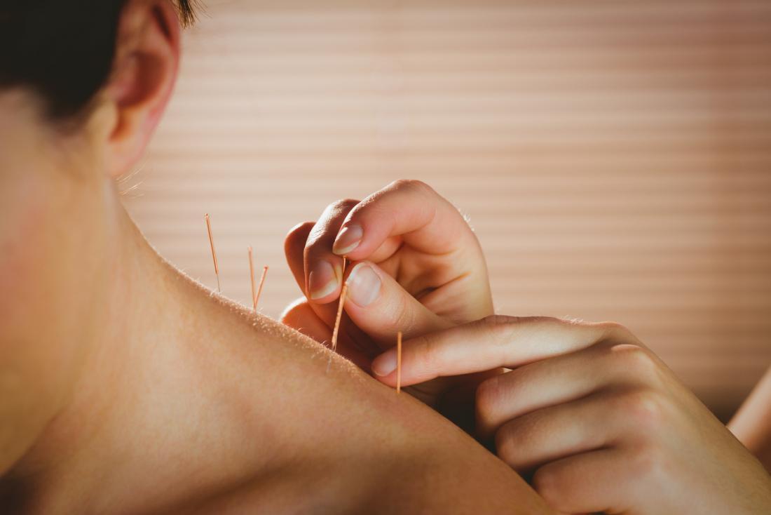 Acupuncture for Neuropathy: Benefits and Risks