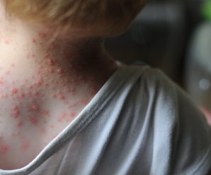 Shingles Prevention With Chickenpox Vaccine