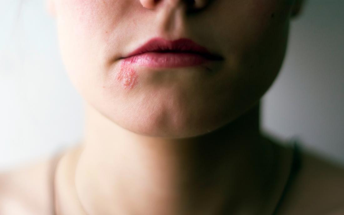 Shingles on the Face: Symptoms, Treatments, and More