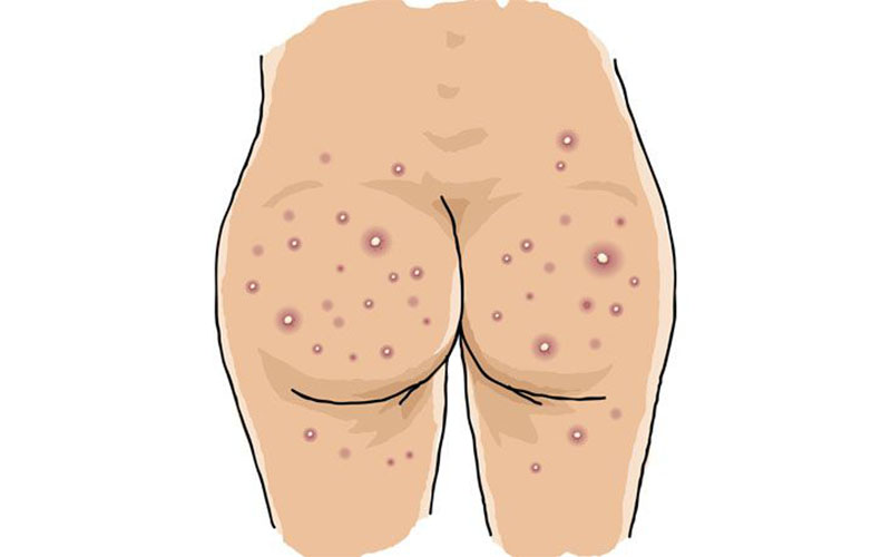Shingles on Buttocks: Symptoms and Treatment