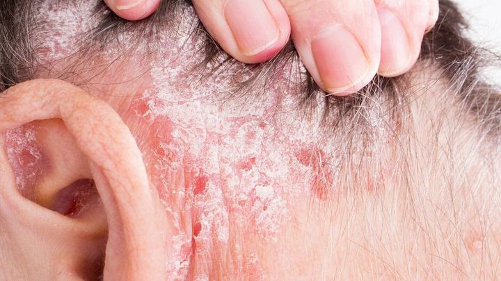 Shingles on Scalp: Symptoms, Causes, Treatment, and Prevention